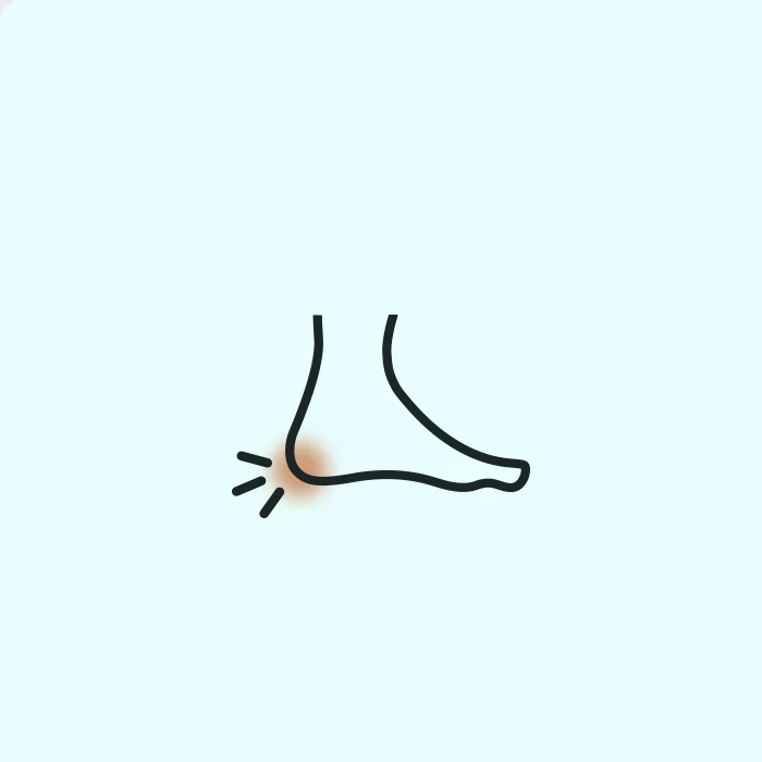 Plantar Fasciitis