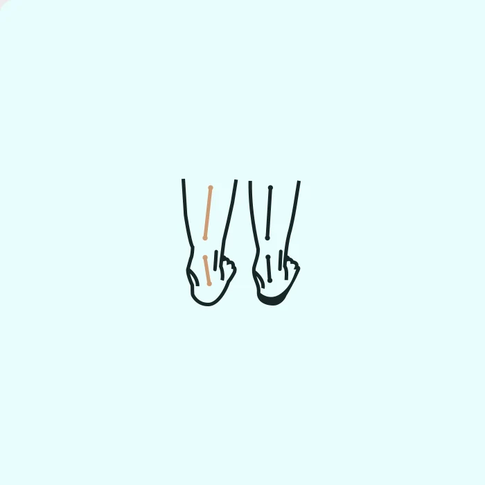 Overpronation